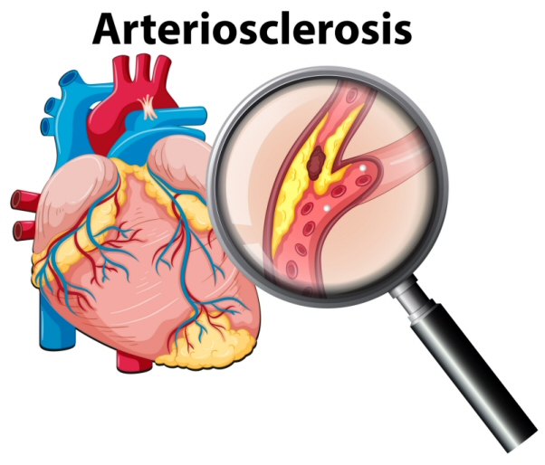 Atherosclerosis - courtesy of Freepik